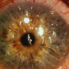 Бржеский В.В. Клинические признаки синдрома «сухого глаза», рис. 38, dry.eye-portal.ru