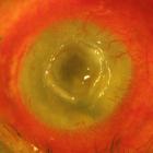 Бржеский В.В. Клинические признаки синдрома «сухого глаза», рис. 41, dry.eye-portal.ru