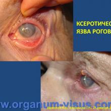 Бржеский В.В., Воронцова Т.Н. Особенности фармакотерапии конъюнктивитов у людей различного возраста. Кафедра офтальмологии с курсом клинической фармакологии СПбГПМУ. Доклад на Интернет-конференции «Место фторхинолонов в профилактике и лечении глазных инфекций». Совместный проект портала Орган зрения organum-visus.com и Всероссийской образовательной программы для врачей "Интернет Сессия" internist.ru Круглый стол для терапевтов и офтальмологов, 17 декабря 2013г., г. Москва. При поддержке компании Dr.Reddy's