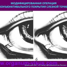 Бржеский В.В. Синдром "сухого глаза": что нового за 5 лет? Dry Eye news. Офтальмологический портал Орган зрения www.organum-visus.com