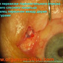 Бржеский В.В. Синдром "сухого глаза": что нового за 5 лет? Dry Eye news. Офтальмологический портал Орган зрения www.organum-visus.com
