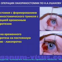 Бржеский В.В., Чистякова М.Н., Калинина И.В., Ефимова Е.Л., Райкова А.С. Современные возможности лакопротезирования у детей. Доклад на Российском общенациональном офтальмологическом форуме (РООФ-2015, AROF-2015). Conjunctivodacryocystorhinostomy. Dry eye. Информационный партнёр www.organum-visus.com