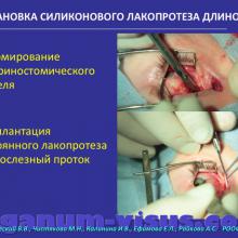 Бржеский В.В., Чистякова М.Н., Калинина И.В., Ефимова Е.Л., Райкова А.С. Современные возможности лакопротезирования у детей. Доклад на Российском общенациональном офтальмологическом форуме (РООФ-2015, AROF-2015). Conjunctivodacryocystorhinostomy. Dry eye. Информационный партнёр www.organum-visus.com