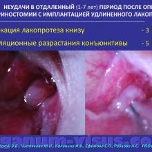 Бржеский В.В., Чистякова М.Н., Калинина И.В., Ефимова Е.Л., Райкова А.С. Современные возможности лакопротезирования у детей. Доклад на Российском общенациональном офтальмологическом форуме (РООФ-2015, AROF-2015). Conjunctivodacryocystorhinostomy. Dry eye. Информационный партнёр www.organum-visus.com