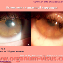Red Eye. Клинический пример 1. Кератит. Осложнение контактной коррекции зрения (Keratitis. Complications of contact lens). Ревта А.М., Ляпушкина Т.Г., 2014г. Офтальмологический портал Орган зрения www.organum-visus.com (4)