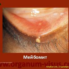 Голубев С.Ю. Инфекция в глазу и рядом (Golubev Sergey. Infection of the eye). Доклад на Интернет-конференции «Место фторхинолонов в профилактике и лечении глазных инфекций». Совместный проект портала Орган зрения organum-visus.com и Всероссийской образовательной программы для врачей "Интернет Сессия" internist.ru Круглый стол для терапевтов и офтальмологов, 17 декабря 2013г., г. Москва, Россия. При поддержке компании Dr.Reddy's