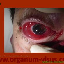 Голубев С.Ю. Офтальмология для терапевтов (Sergey Y. Golubev, Ophthalmology for therapists). Доклад на интернет-сессии: Инфекция в глазу! Internet-session: Ophthalmology for Therapists! (г. Москва, Россия, 22 октября 2014г.) Совместный проект портала Орган зрения organum-visus.com и Всероссийской образовательной программы для врачей "Интернет Сессия". При поддержке компании Dr.Reddy's
