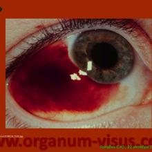 Голубев С.Ю. Офтальмология для терапевтов (Sergey Y. Golubev, Ophthalmology for therapists). Доклад на интернет-сессии: Инфекция в глазу! Internet-session: Ophthalmology for Therapists! (г. Москва, Россия, 22 октября 2014г.) Совместный проект портала Орган зрения organum-visus.com и Всероссийской образовательной программы для врачей "Интернет Сессия". При поддержке компании Dr.Reddy's