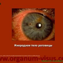 Голубев С.Ю. Офтальмология для терапевтов (Sergey Y. Golubev, Ophthalmology for therapists). Доклад на интернет-сессии: Инфекция в глазу! Internet-session: Ophthalmology for Therapists! (г. Москва, Россия, 22 октября 2014г.) Совместный проект портала Орган зрения organum-visus.com и Всероссийской образовательной программы для врачей "Интернет Сессия". При поддержке компании Dr.Reddy's