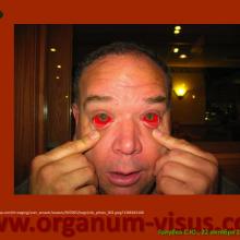 Голубев С.Ю. Офтальмология для терапевтов (Sergey Y. Golubev, Ophthalmology for therapists). Доклад на интернет-сессии: Инфекция в глазу! Internet-session: Ophthalmology for Therapists! (г. Москва, Россия, 22 октября 2014г.) Совместный проект портала Орган зрения organum-visus.com и Всероссийской образовательной программы для врачей "Интернет Сессия". При поддержке компании Dr.Reddy's