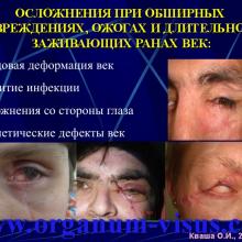 Кваша О.И. NO-терапия в офтальмотравматологии. Экспериментально-клиническое исследование. Гундорова Р.А., Чеснокова Н.Б., Кваша О.И., Шехтер А.Б., Пекшев А.В., Давыдова Н.Г., Безнос О.В., Столярова Е.П., Горбачева О.В., Косакян С.М., Сиала С. (МНИИ глазных болезней им. Гельмгольца (директор - д.м.н., профессор В.В.Нероев) Отдел травм органа зрения, реконструктивной хирургии и глазного протезирования (руководитель – д.м.н., профессор Р.А.Гундорова)), Kvasha O.I. NO-therapy in ophthalmology.
