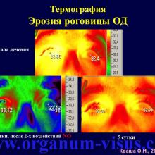 Кваша О.И. NO-терапия в офтальмотравматологии. Экспериментально-клиническое исследование. Гундорова Р.А., Чеснокова Н.Б., Кваша О.И., Шехтер А.Б., Пекшев А.В., Давыдова Н.Г., Безнос О.В., Столярова Е.П., Горбачева О.В., Косакян С.М., Сиала С. (МНИИ глазных болезней им. Гельмгольца (директор - д.м.н., профессор В.В.Нероев) Отдел травм органа зрения, реконструктивной хирургии и глазного протезирования (руководитель – д.м.н., профессор Р.А.Гундорова)), Kvasha O.I. NO-therapy in ophthalmology.