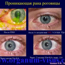 Кваша О.И. NO-терапия в офтальмотравматологии. Экспериментально-клиническое исследование. Гундорова Р.А., Чеснокова Н.Б., Кваша О.И., Шехтер А.Б., Пекшев А.В., Давыдова Н.Г., Безнос О.В., Столярова Е.П., Горбачева О.В., Косакян С.М., Сиала С. (МНИИ глазных болезней им. Гельмгольца (директор - д.м.н., профессор В.В.Нероев) Отдел травм органа зрения, реконструктивной хирургии и глазного протезирования (руководитель – д.м.н., профессор Р.А.Гундорова)), Kvasha O.I. NO-therapy in ophthalmology.