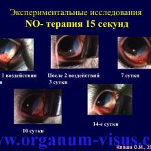 Кваша О.И. NO-терапия в офтальмотравматологии. Экспериментально-клиническое исследование. Гундорова Р.А., Чеснокова Н.Б., Кваша О.И., Шехтер А.Б., Пекшев А.В., Давыдова Н.Г., Безнос О.В., Столярова Е.П., Горбачева О.В., Косакян С.М., Сиала С. (МНИИ глазных болезней им. Гельмгольца (директор - д.м.н., профессор В.В.Нероев) Отдел травм органа зрения, реконструктивной хирургии и глазного протезирования (руководитель – д.м.н., профессор Р.А.Гундорова)), Kvasha O.I. NO-therapy in ophthalmology.