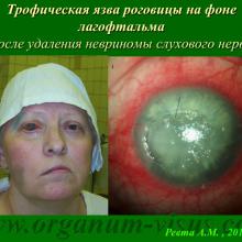Ревта А.М. Конъюнктивальное пломбирование как метод выбора в хирургии язв роговицы. Доклад на Областной научно-практической конференции «Актуальные вопросы офтальмологии» (26 июня 2015 года, г. Архангельск, Россия). Портал Орган зрения www.organum-visus.com