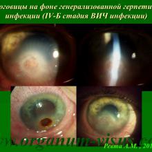 Ревта А.М. Конъюнктивальное пломбирование как метод выбора в хирургии язв роговицы. Доклад на Областной научно-практической конференции «Актуальные вопросы офтальмологии» (26 июня 2015 года, г. Архангельск, Россия). Портал Орган зрения www.organum-visus.com